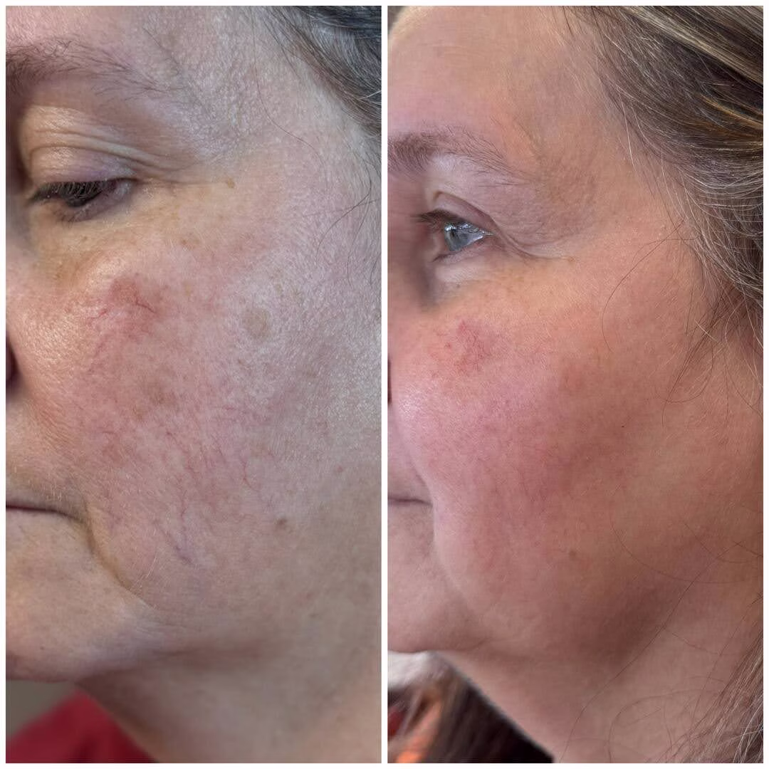 Lumecca Peak Treatments in New Tazewell, Tennessee